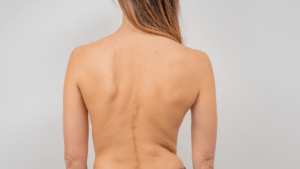 A blonde woman with scoliosis